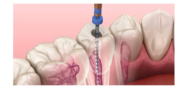 Root Canal Therapy Navi Mumbai